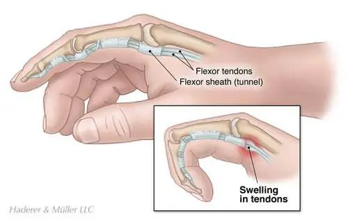 injuries-in-boxing-trigger-finger